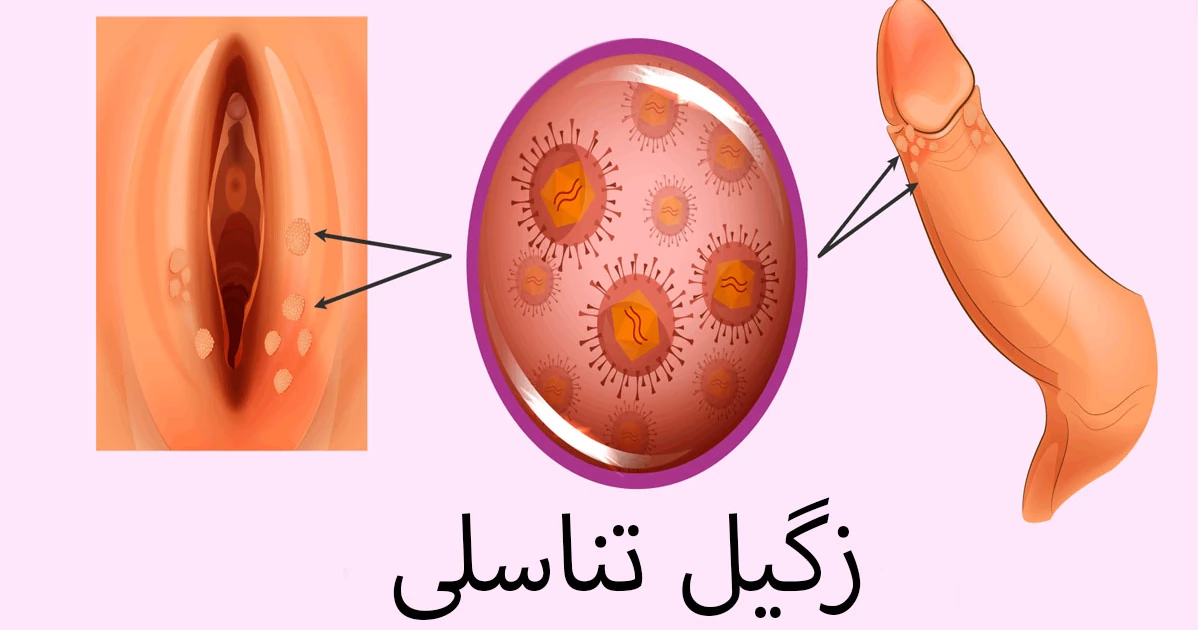 علائم و نشانه‌های زگیل تناسلی چیست؟