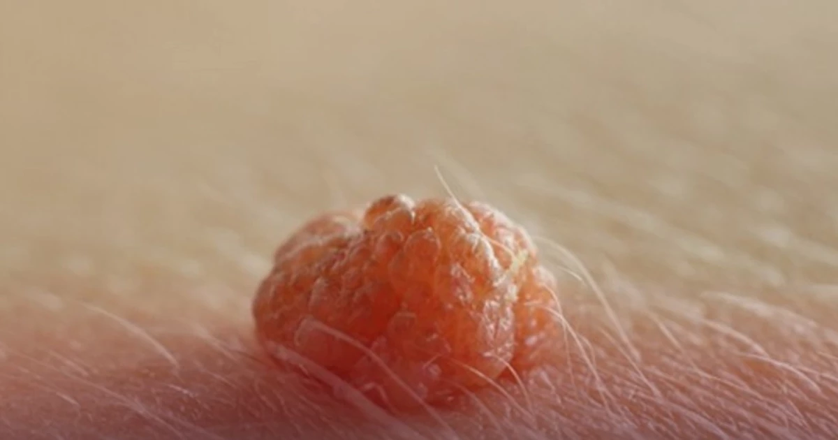 زگیل تناسلی چگونه درمان می‌شود؟