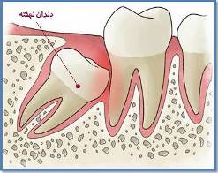 دندان نهفته