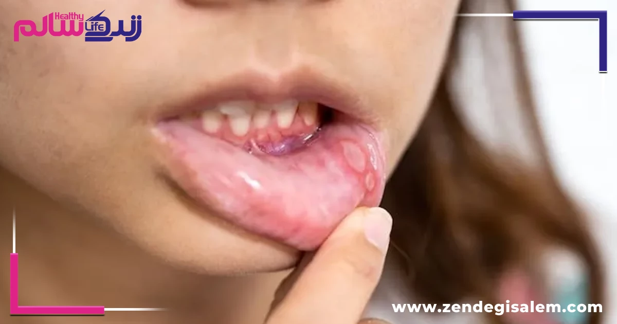 علت ایجاد آفت دهان چیست؟
