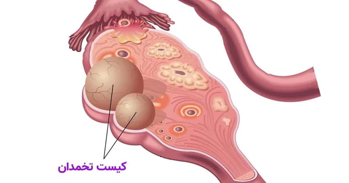 ۲. تشکیل کیست‌های تخمدانی