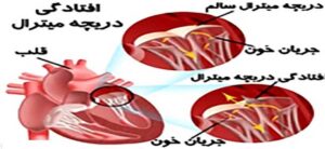 افتادگی دریچه میترال