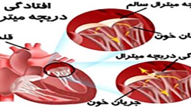 افتادگی دریچه میترال