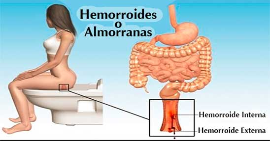 همروئید یا بواسیر