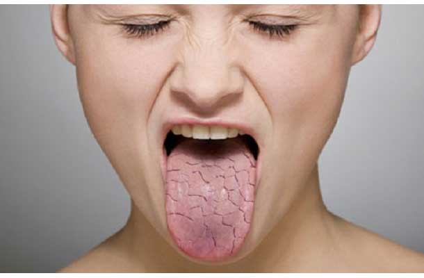 علت خشکی دهان چیست؟