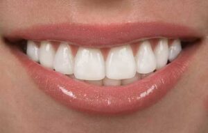 آیا روش طرح بندی برای دندانهای فاصله دار مناسب است؟
