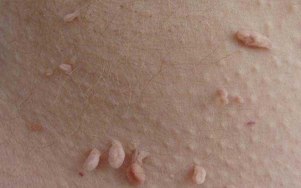 درمان زائده های روی پوست