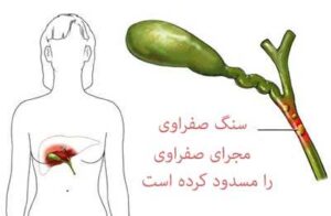 روشهای تشخیص و درمان سنگهای صفراوی چگونه است؟