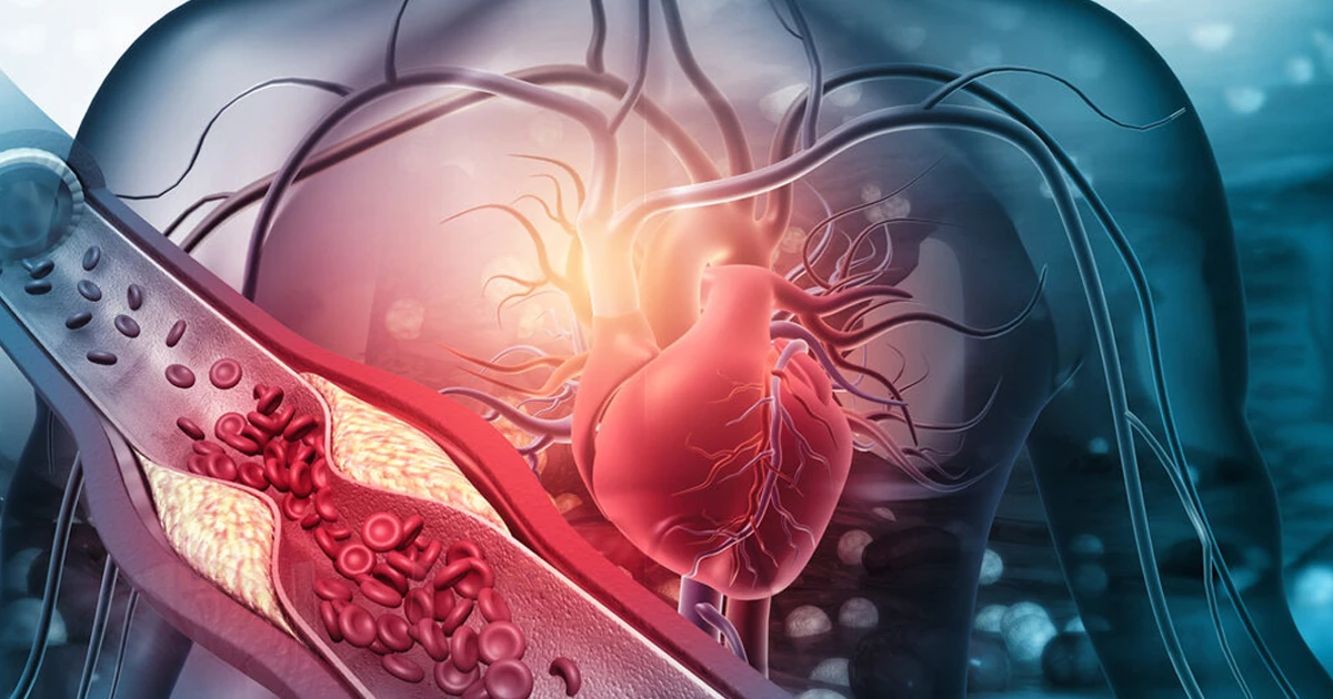 چه وقت تصلب شرایین، علت ایجاد سکته است؟