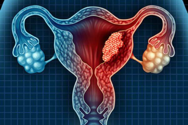 درمان سرطان رحم در زنان