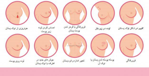 علائم شایع سرطان سینه