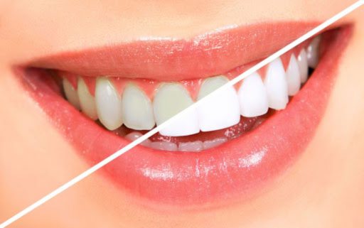آسیب کیت های سفید کننده به مینای دندان