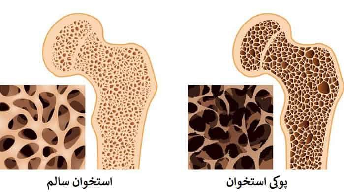 پیشگیری از پوکی استخوان