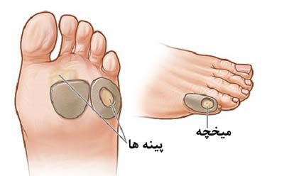 پیشگیری از پینه و میخچه