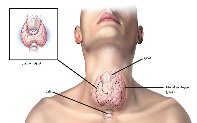 پرکاری غده‌ی تیروئید