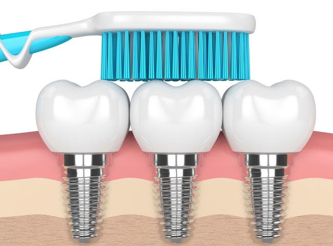 مراقبت از ایمپلنت دندان