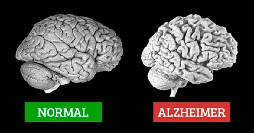 مغز مبتلا به آلزایمر و بدون آلزایمر