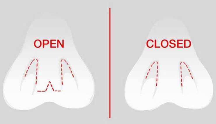 جراحی بینی باز و بسته