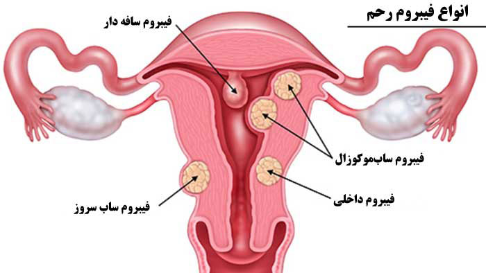 ایجاد فیبروم رحم