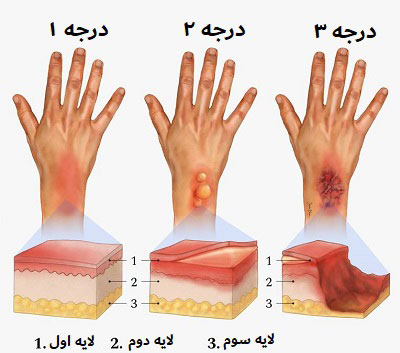 درمان انواع سوختگی با بهترین پماد سوختگی پوست