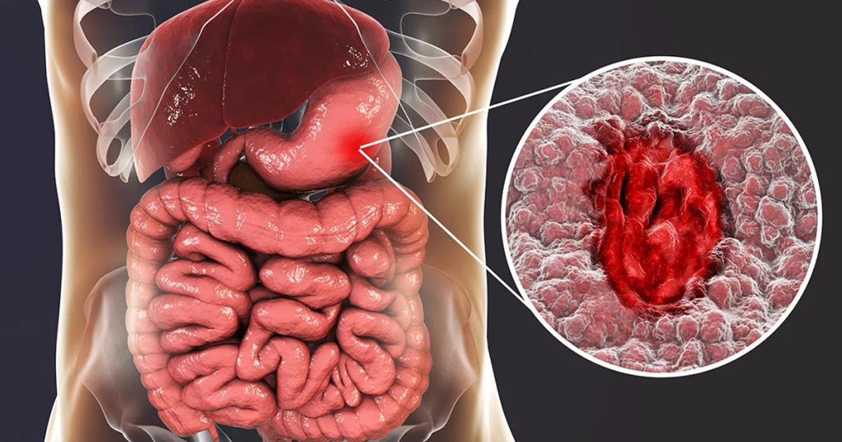 آیا غذا نخوردن باعث زخم معده می‌شود؟