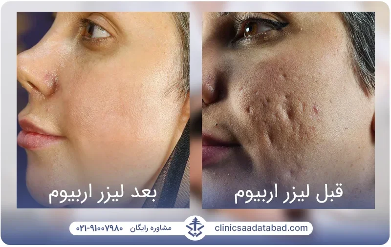 تصاویر قبل و بعد درمان جای جوش و اسکار عمیق پوست توسط لیزر اربیوم