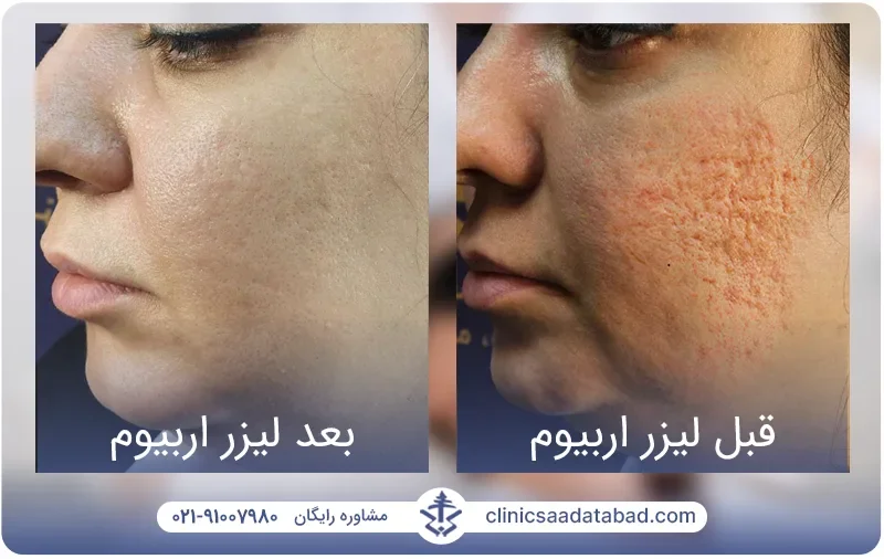 تصاویر قبل و بعد درمان جای جوش و اسکار عمیق پوست توسط لیزر اربیوم