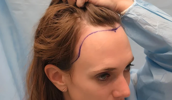 هزینه کاشت مو در آقایان و خانمها