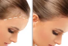 بررسی هزینه کاشت مو در آقایان و خانم‌ها