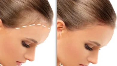 بررسی هزینه کاشت مو در آقایان و خانم‌ها