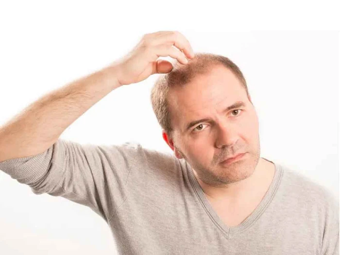 کاشت مو در آقایان