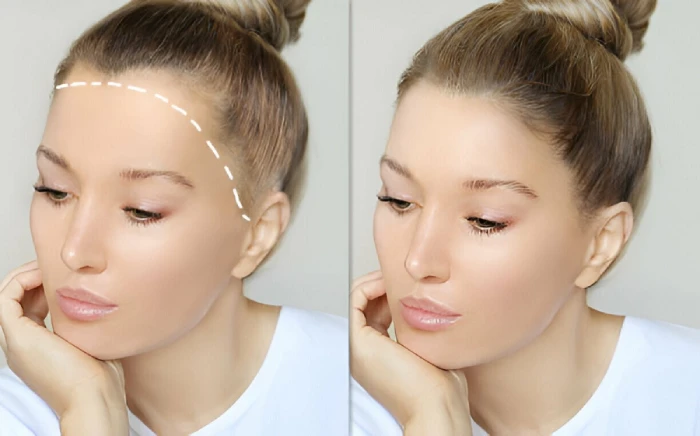 کاشت مو در خانمها