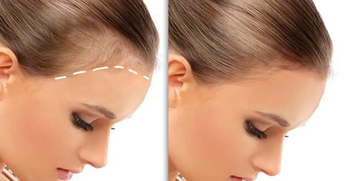 بررسی هزینه کاشت مو در آقایان و خانمها