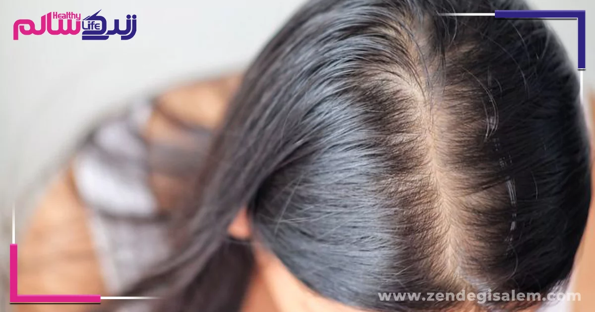 چگونه ریزش مو را درمان کنیم؟