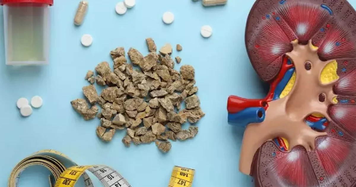 پیشگیری از سنگ کلیه و نارسایی کلیوی