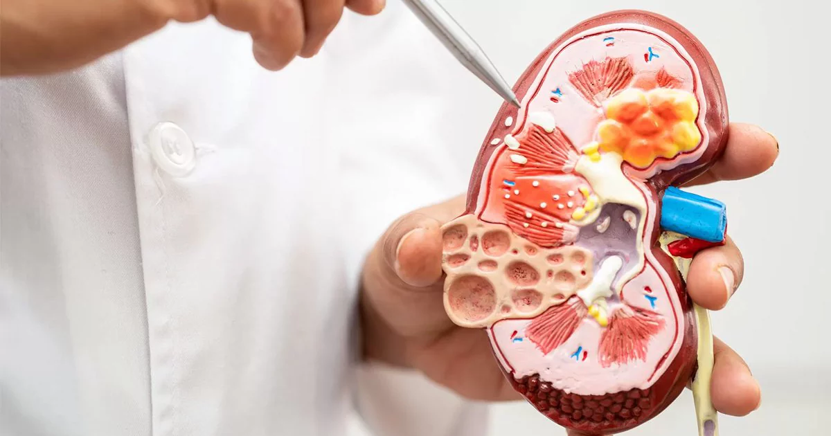 آیا سنگ کلیه باعث نارسایی کلیه میشود؟