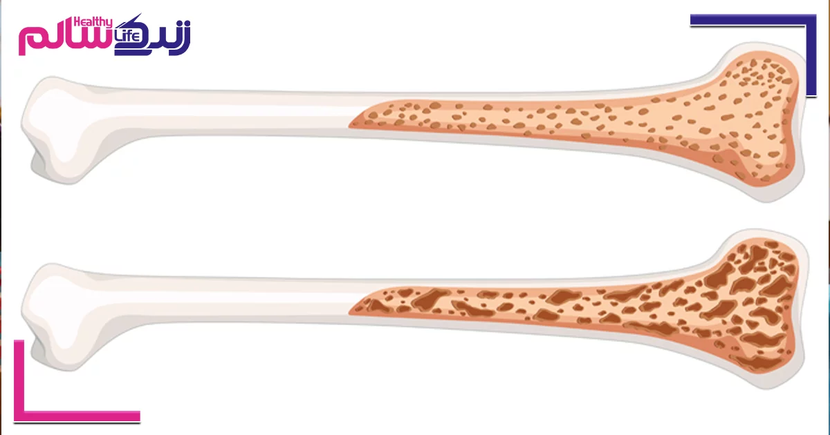 پوکی استخوان چیست و چه کسانی بیشتر مبتلا می‌ شوند؟