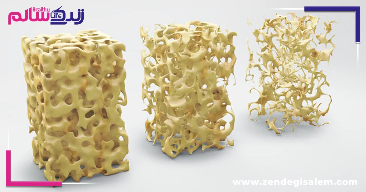 پیشگیری از پوکی استخوان: سه رکن طلایی از کودکی تا سالمندی