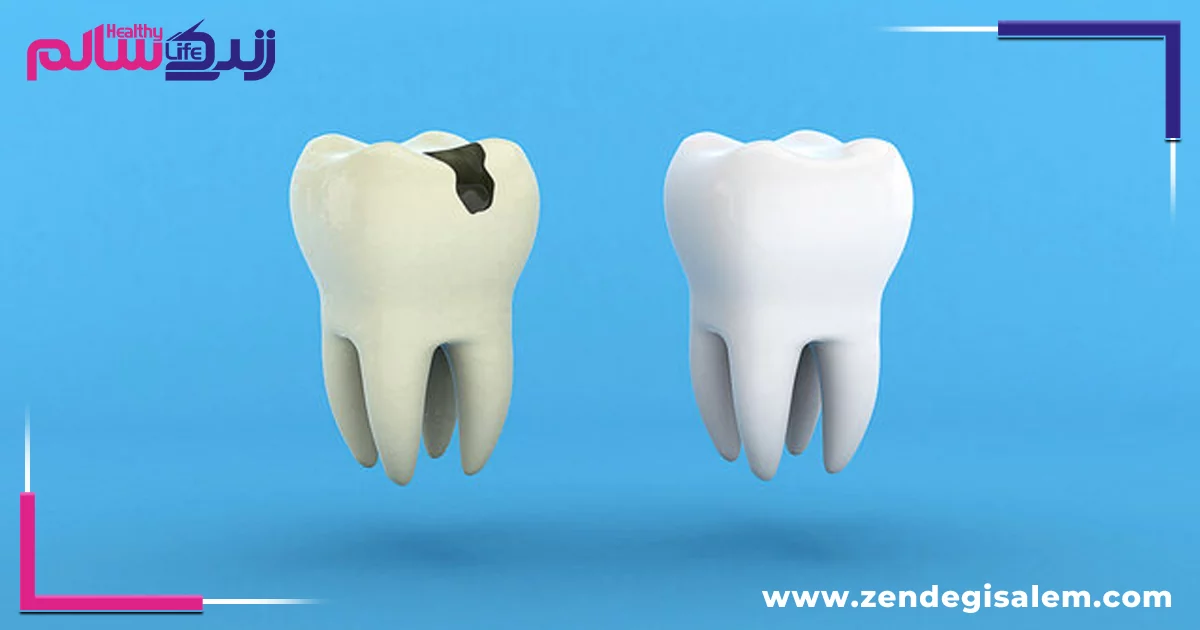 عواقب پوسیدگی دندان