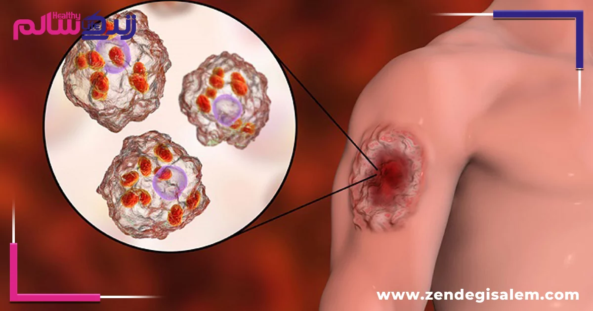 درصورت گزش پشه سالک با این کار جای زخم را از بین ببر