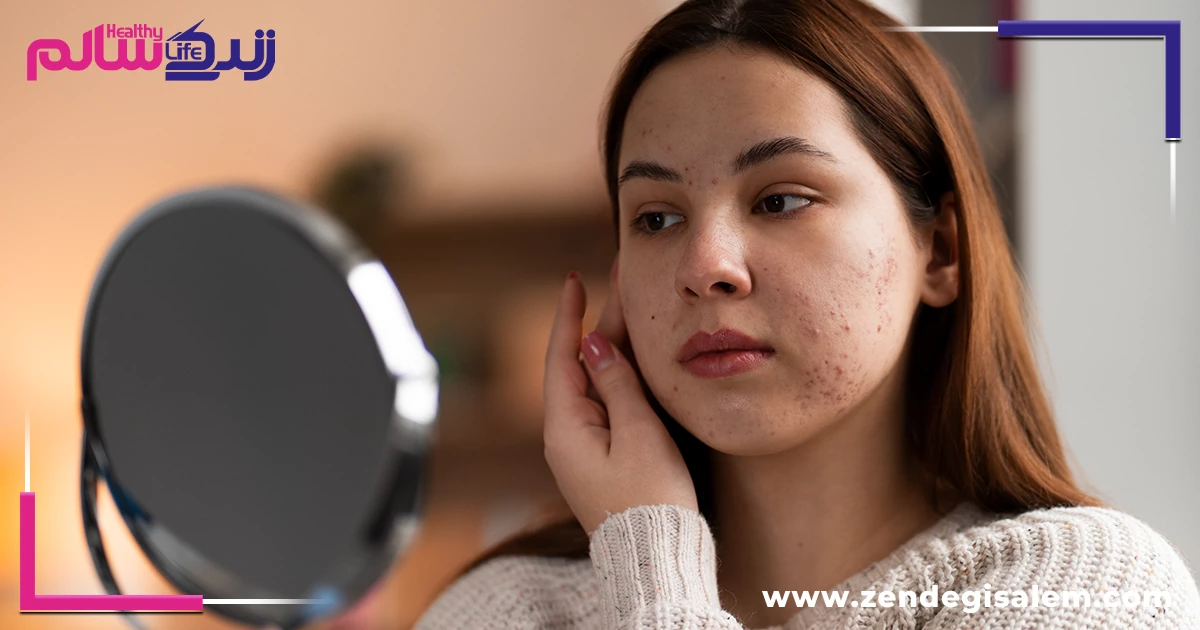 بهترین روش‌های درمان جوش صورت و از بین بردن جای جوش