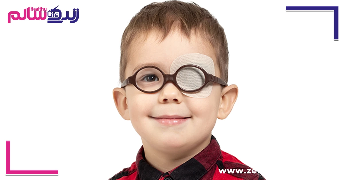 تنبلی چشم در کودکان