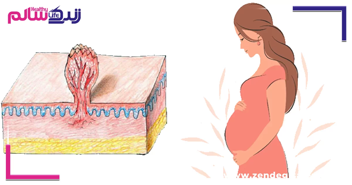 زگیل تناسلی در بارداری؛ تأثیرات آن بر مادر و جنین
