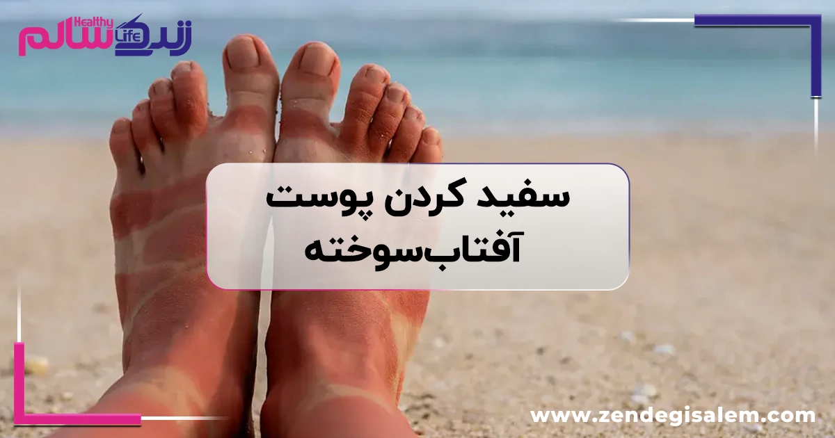 سفید کردن پوست آفتابسوخته؛ ۷ روش مؤثر خانگی برای روشن کردن و ترمیم پوست