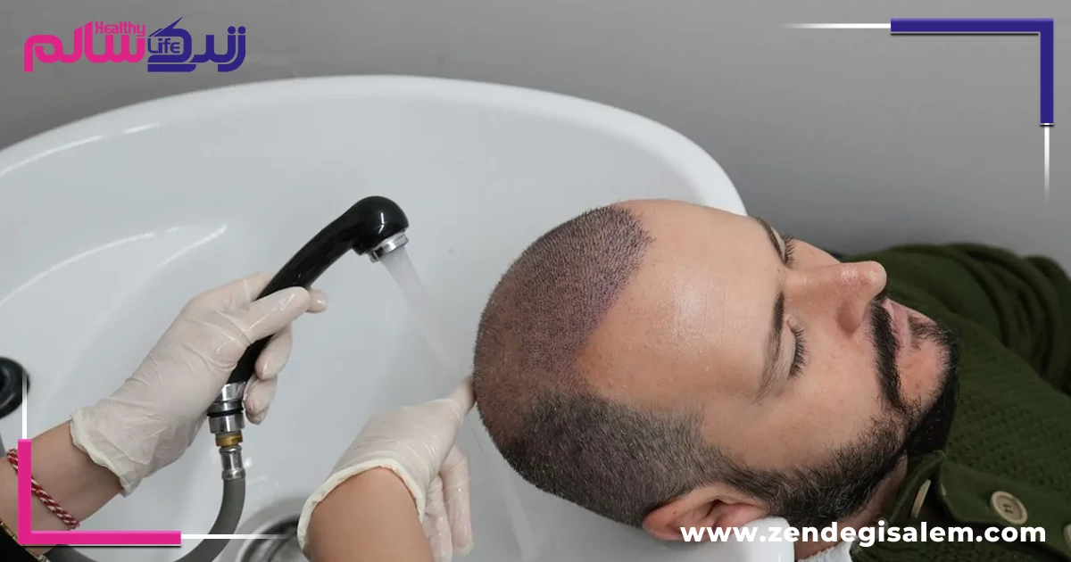 شامپو بدون سولفات بعد از کاشت مو